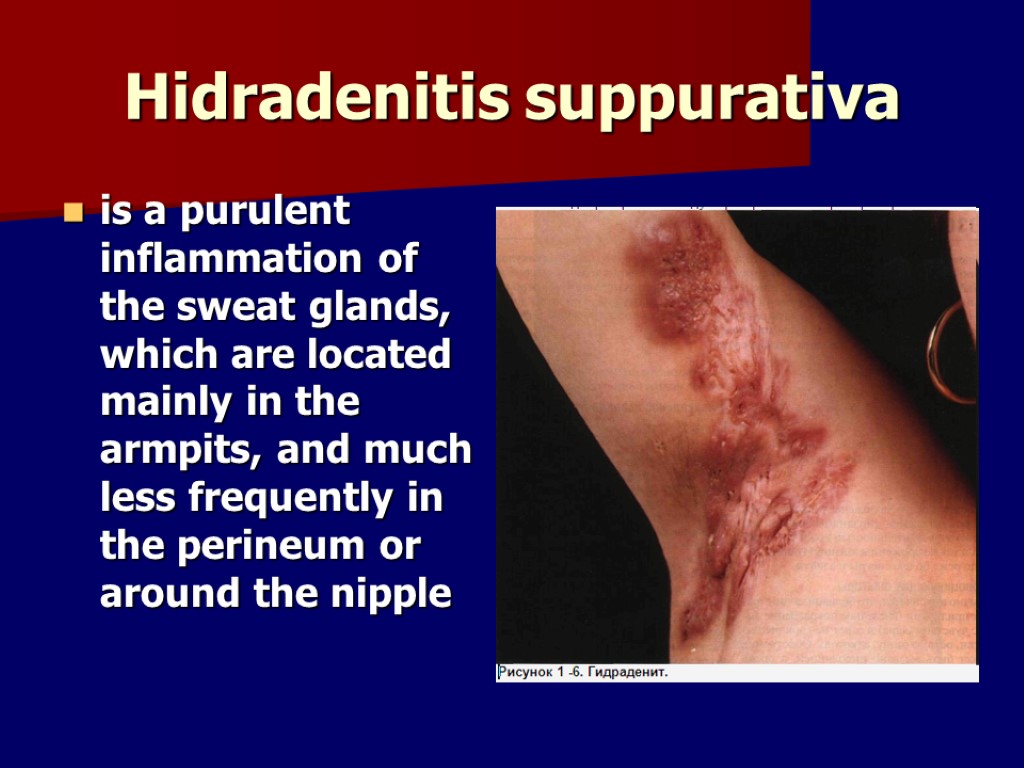 Hidradenitis suppurativa is a purulent inflammation of the sweat glands, which are located mainly